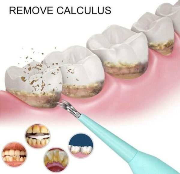 140203854 62f0e1b1191cf5 43207012e30d8a8e 0a2e 4 - Aparat za uklanjanje zubnog kamenca Ciscenje zuba – Aparat za uklanjanje zubnog kamenca Ciscenje zuba Aparat za uklanjanje zubnog kamenca Ciscenje zuba – Aparat za uklanjanje zubnog kamenca Ciscenje zuba